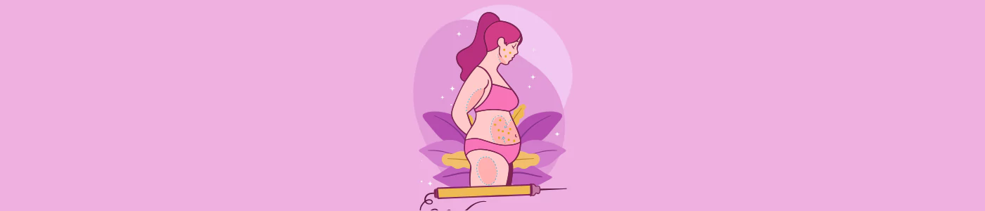 Acne During Pregnancy: Understanding Causes and Treatment Options