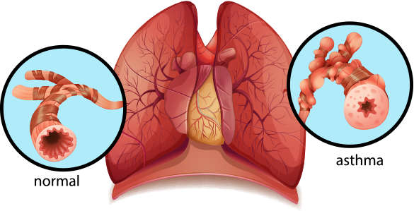 asthma inflamed bronchial tube